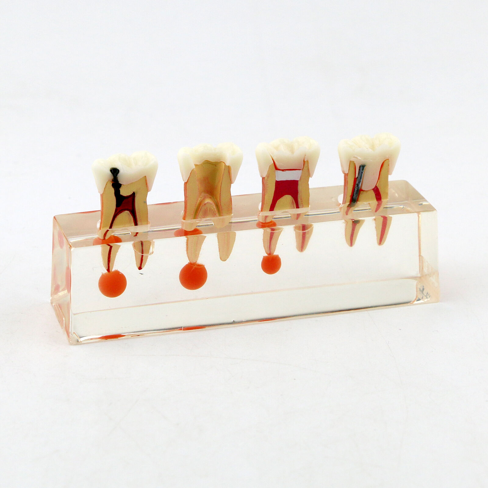 Dental Model #4018 01 - 4-Stage Endodontic Treatment Model