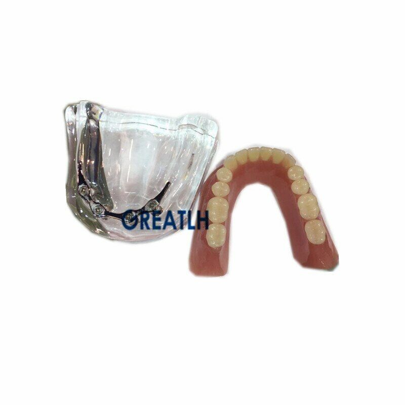 Dental Teeth Repair Model Mandibular with Silver Bar TeachingStudy Model