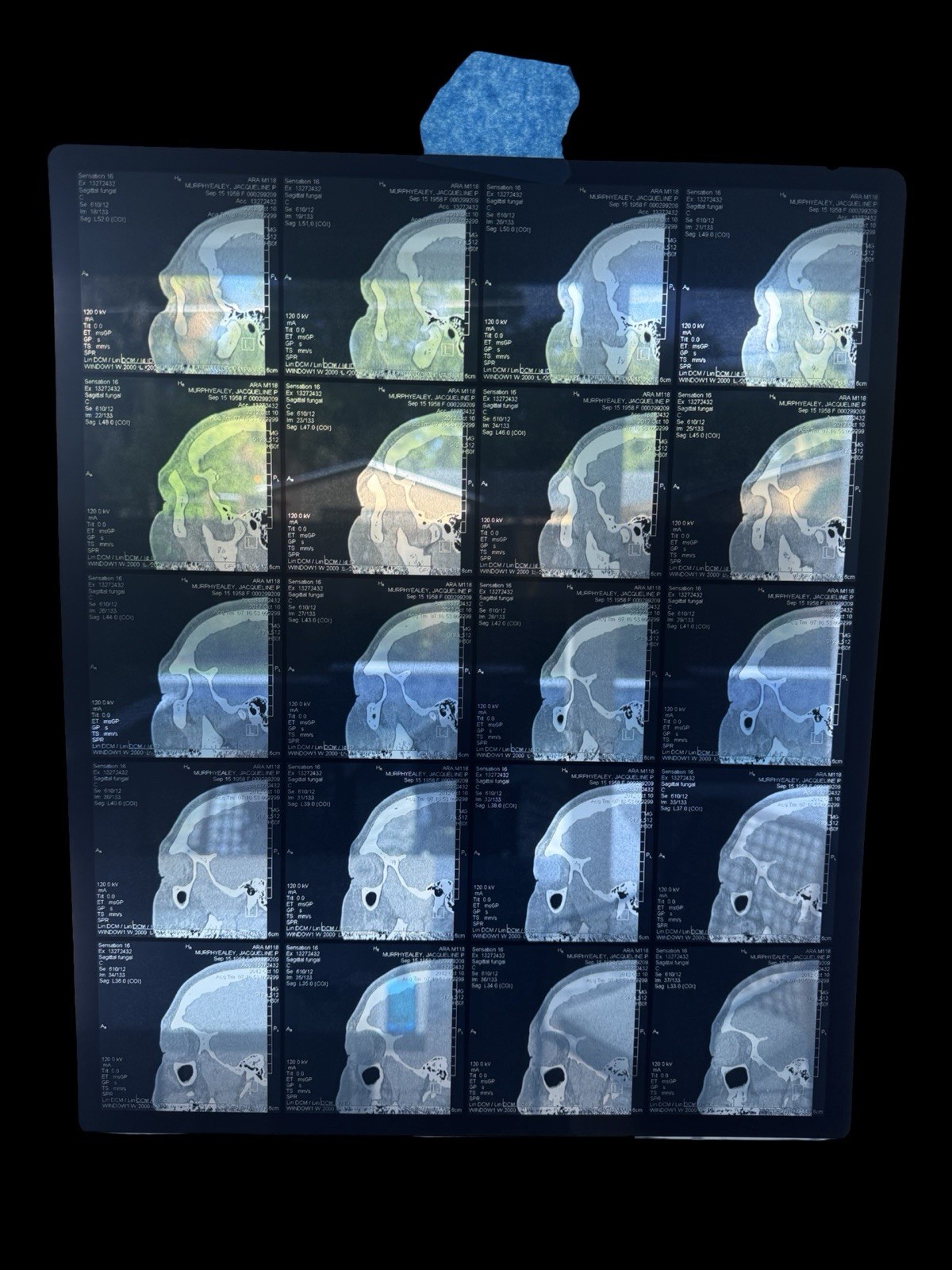 Vintage Medical CT Scan Film Skull Sinus Profile X-Ray Radiology Sheet Skull Vintage Medical CT Scan Film Skull Sinus Profile X-Ray Radiology Sheet Skull