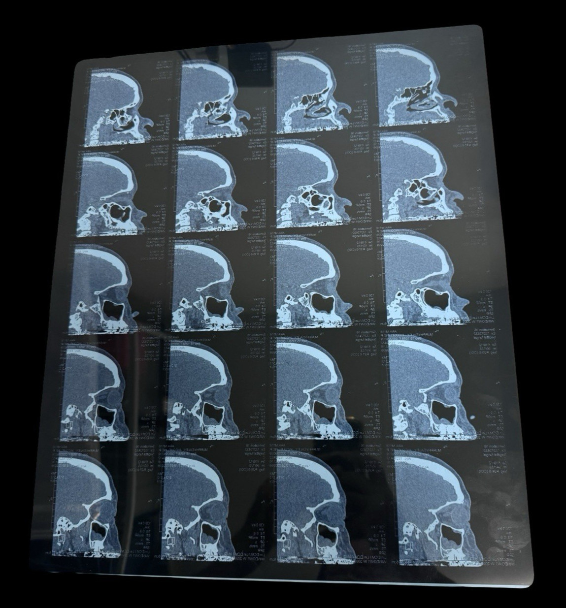 Vintage CT Scan X-Ray Film Sinus Skull Medical Imaging Radiology Transparency