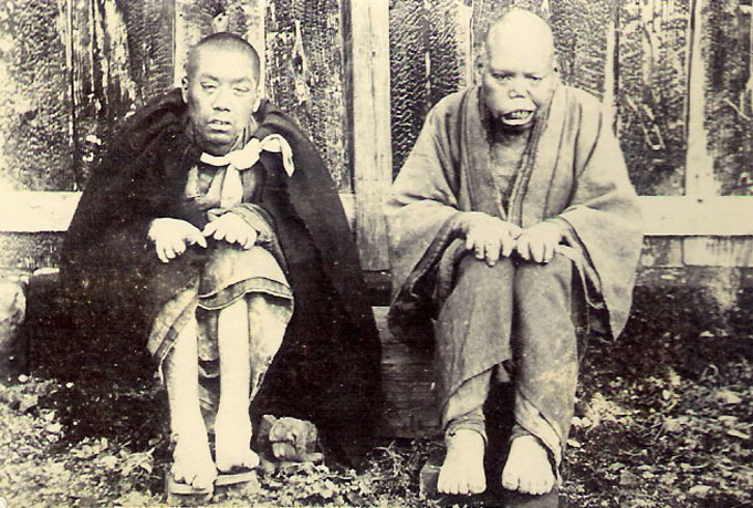 GROTESQUE Antique DEFORMITY DISEASE LEPROSY Rare PHOTO 1870 Expedition FREAKS GROTESQUE Antique DEFORMITY DISEASE LEPROSY Rare PHOTO 1870 Expedition FREAKS